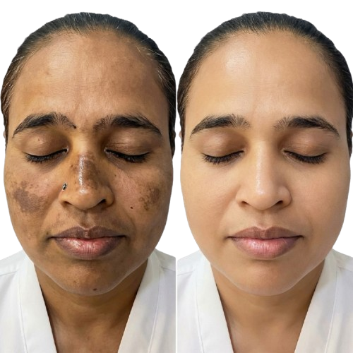 Pigmentation Treatment
